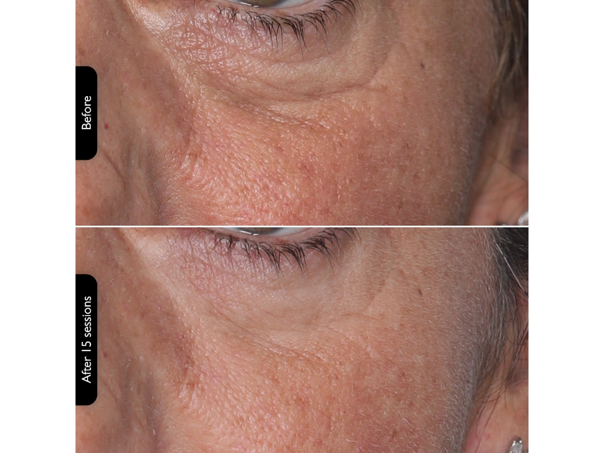 Silk'n Facial LED Mask Ansiktspleie