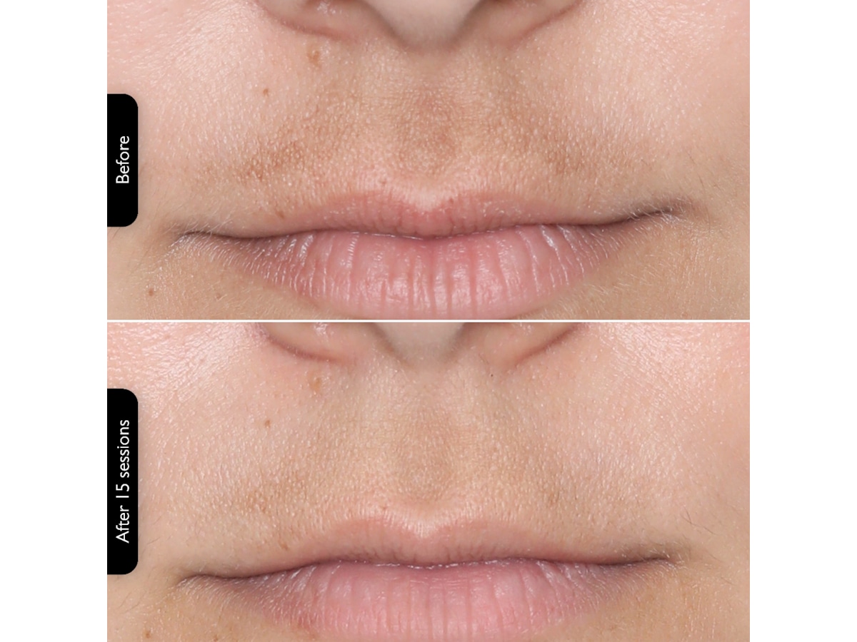 Silk'n Facial LED Mask Ansiktspleie