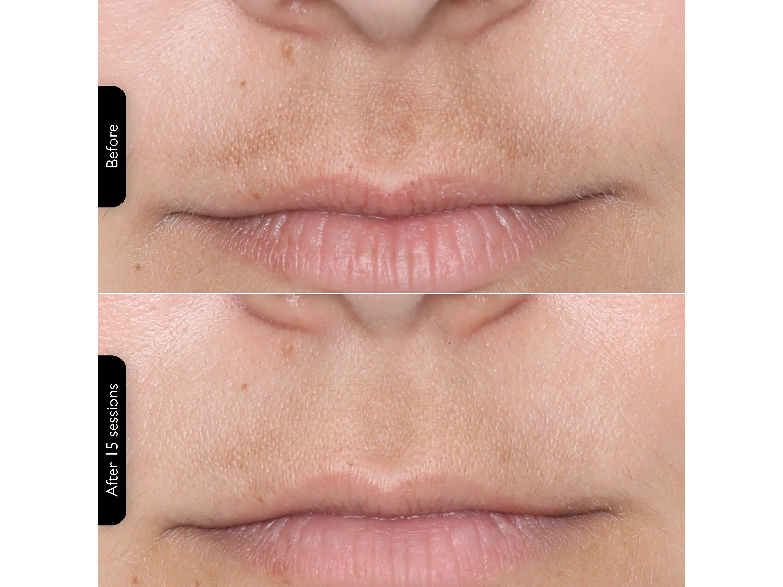 Silk'n Facial LED Mask Ansiktspleie