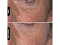 Silk'n Facial LED Mask Ansiktspleie