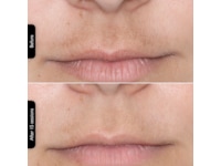 Silk'n Facial LED Mask Ansiktspleie